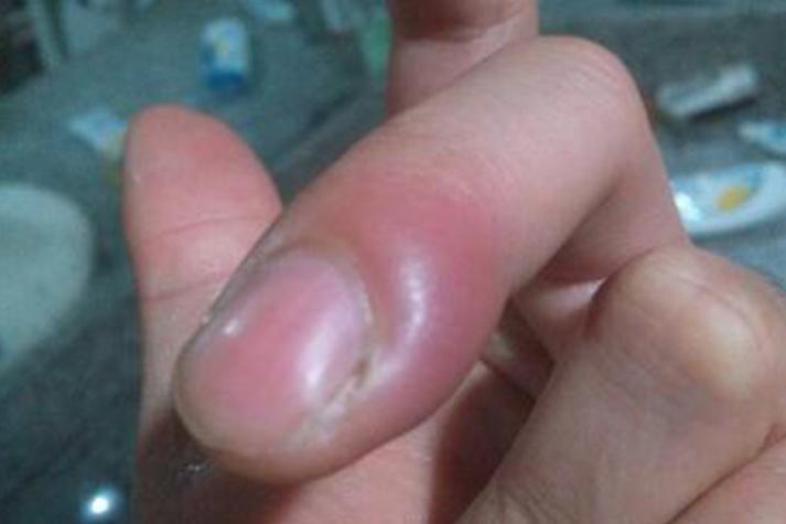 甲沟炎严重的图片