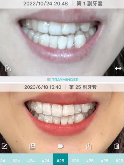 时代天使60副要戴多久