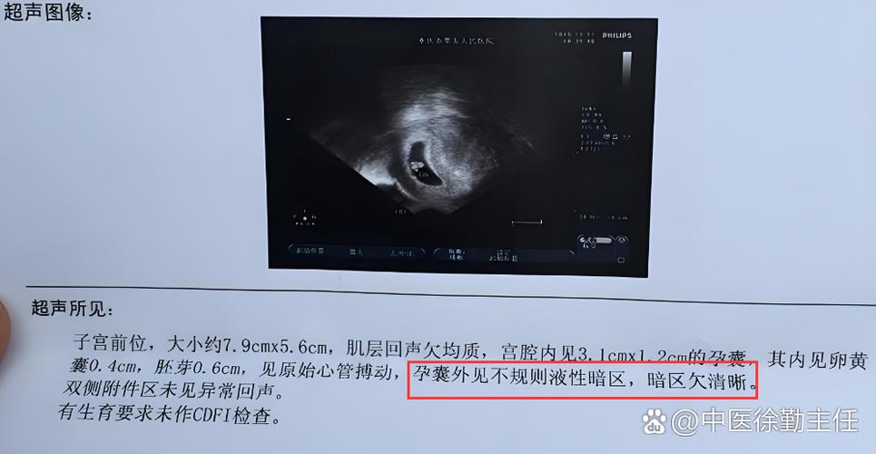 液性暗区是早期孕囊吗