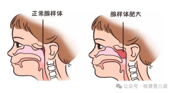 扣鼻子的预防措施