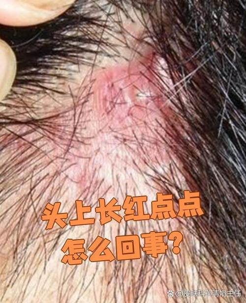 头皮红点点是怎么回事