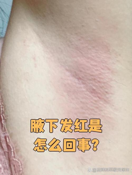 胳肢窝发红发痒是怎么回事截图