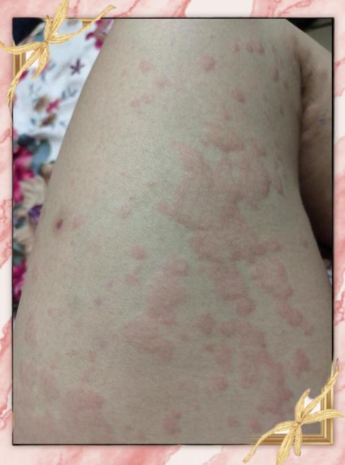 皮肤痒是湿热还是寒湿