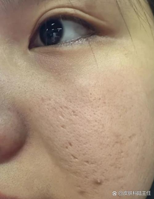 脸上的小坑拿什么填补