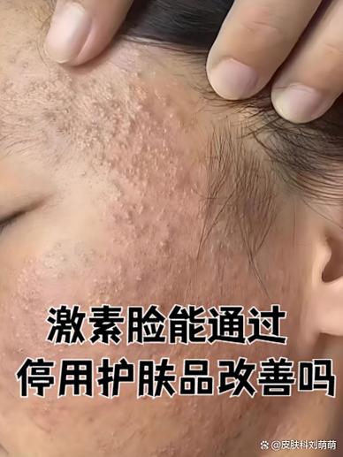 皮肤屏障受损怎么修复