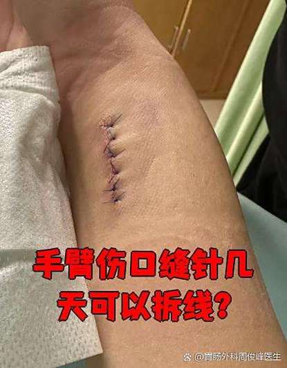 缝针伤口发紫