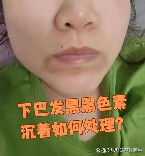 面部发暗发黑的原因
