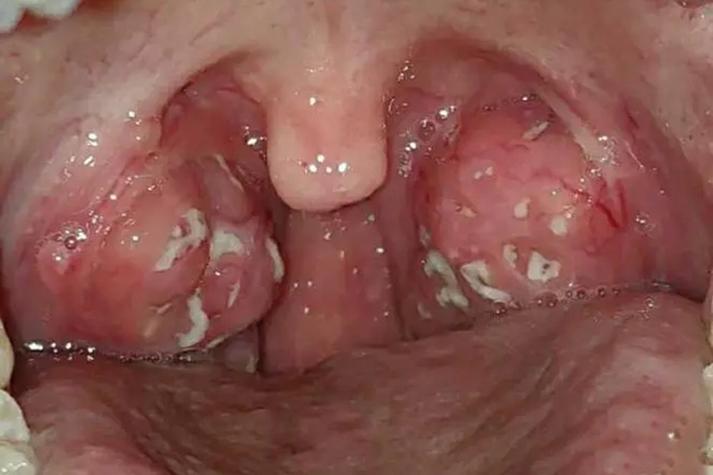 喉咙里有一股腐烂臭味