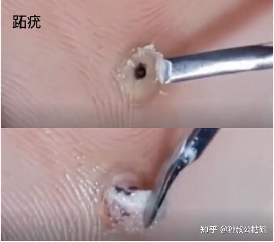 跖疣在肉里有多深