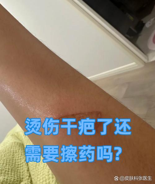 烫伤干疤了还需要擦药吗