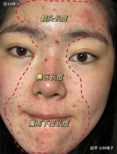 脸上长痘痘了怎么办最快消除