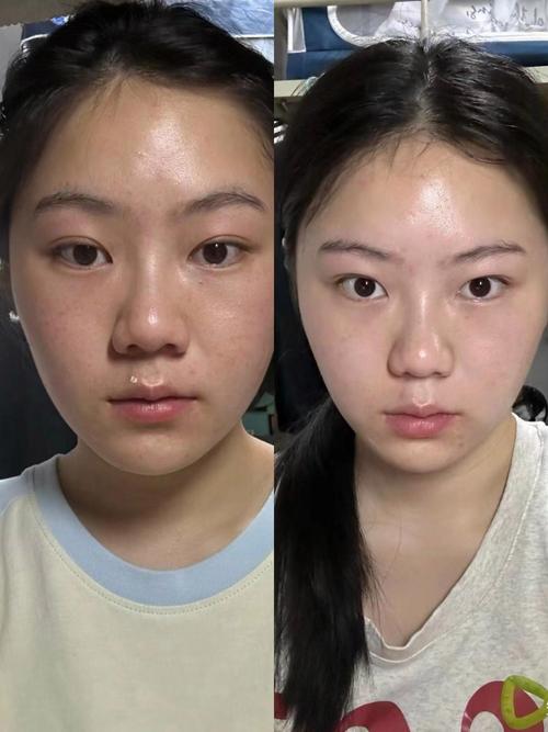 深蓝射频好还是热玛吉效果好