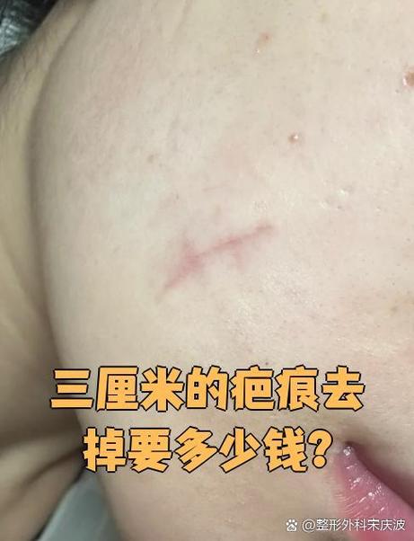 缝针的疤痕能去掉吗截图