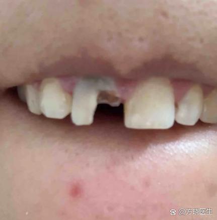 大人牙齿断了可以接上吗