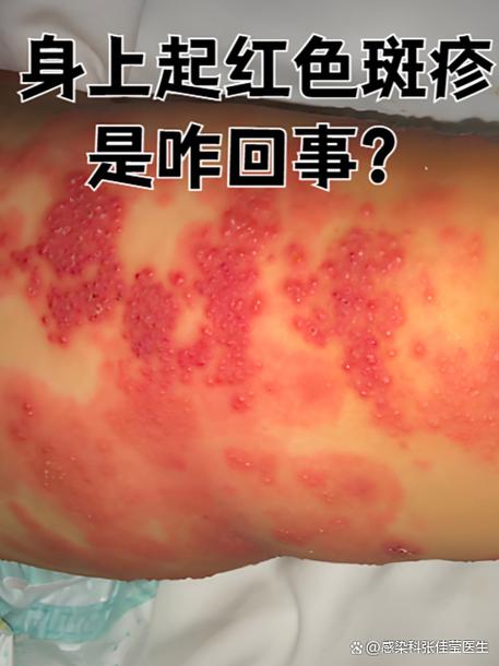 红疮狼斑会传染吗