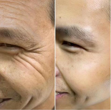 40岁男人如何去皱纹