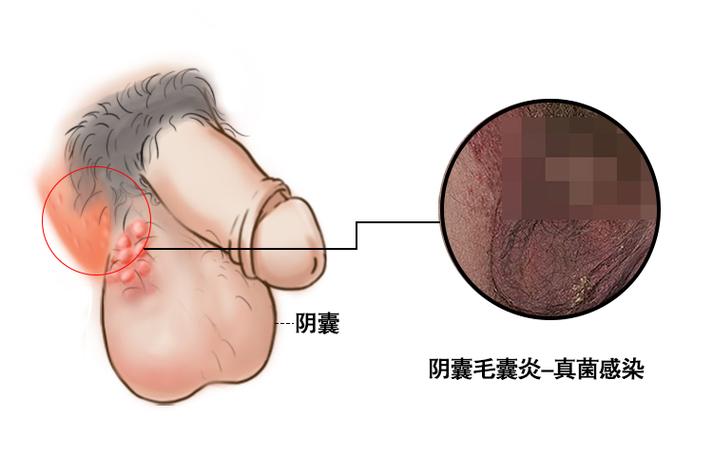 男性真菌感染症状图片