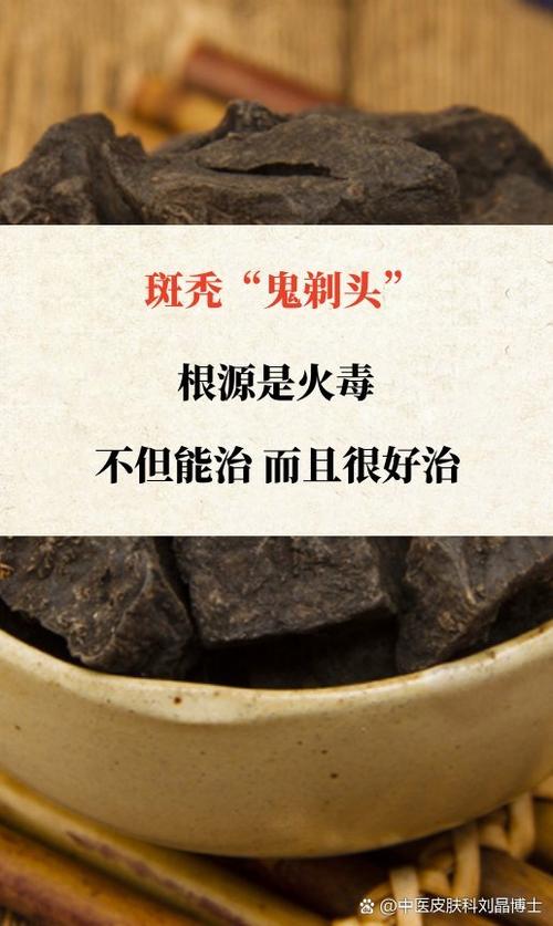 鬼剃头民间偏方