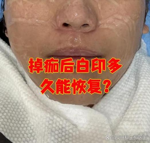 掉痂以后有一个白色印子叫什么截图
