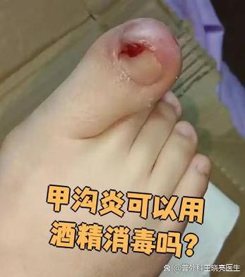 甲沟炎能自愈吗