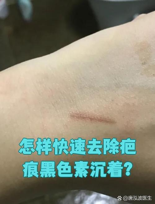 皮肤伤疤黑色素沉淀怎么除掉