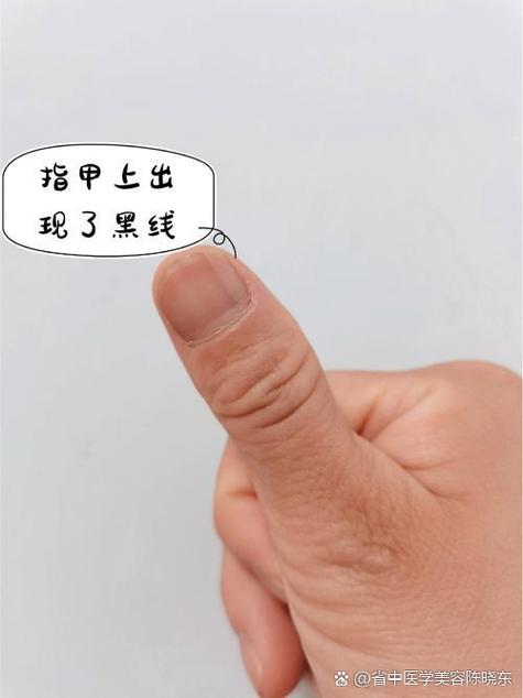 女性食指有黑线要警惕截图