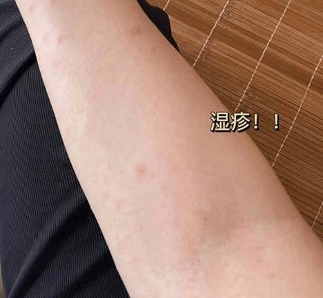 湿疹怎么治好得快图标