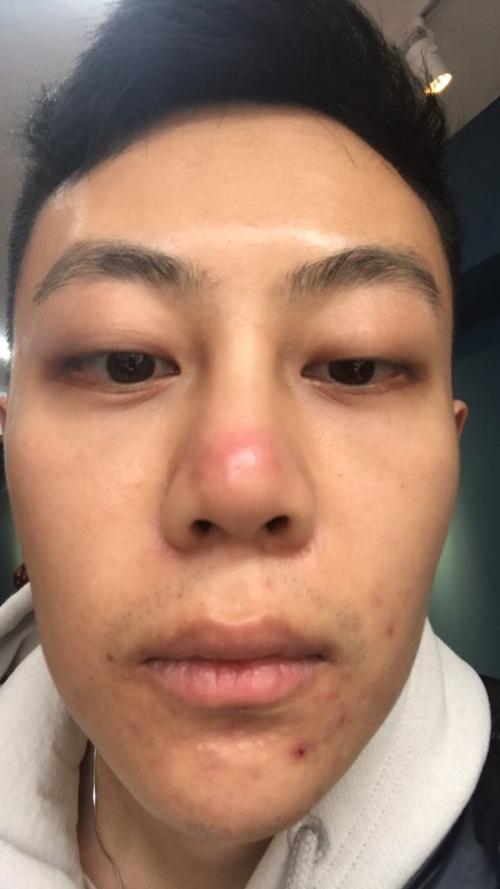 鼻子上长红肿的包