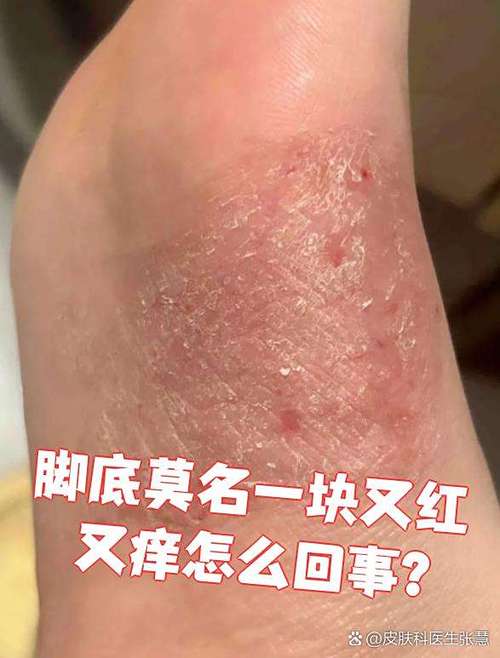 脚底板一碰就痒