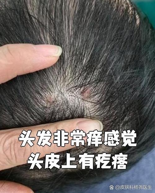头皮止痒妙招