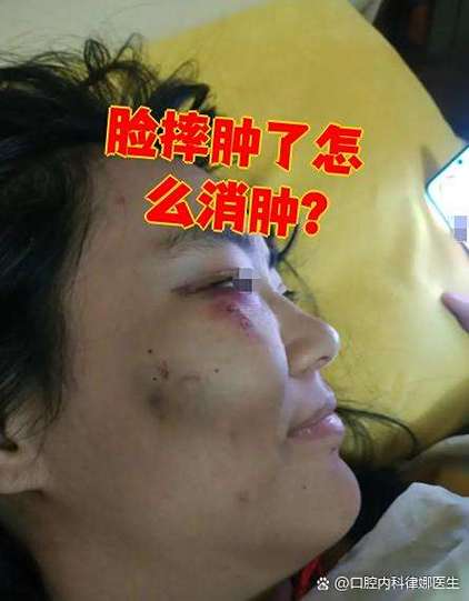 脸摔跤肿了怎么消肿最快