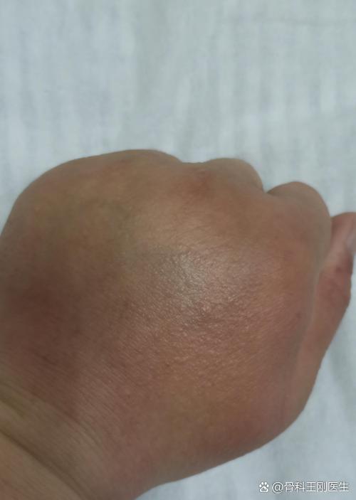 经常用拳头打墙会怎么样