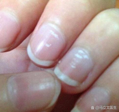 手指甲变白的5个征兆