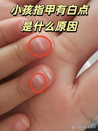 指甲盖发白是什么原因造成的