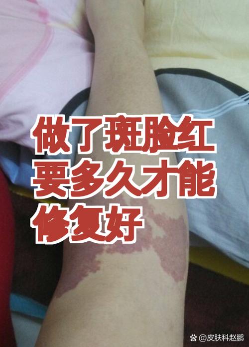 做斑之后要多久才能修复好