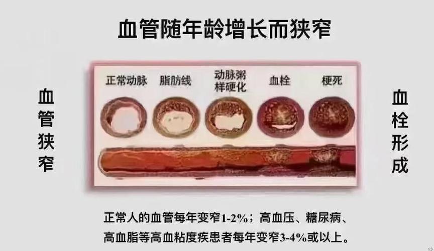 血管堵塞90%可以保守治疗吗