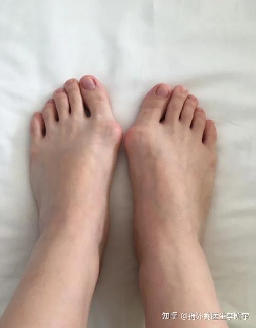 女性外翻正常吗