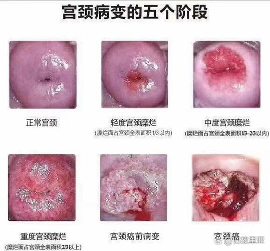 重度糜烂需要治疗