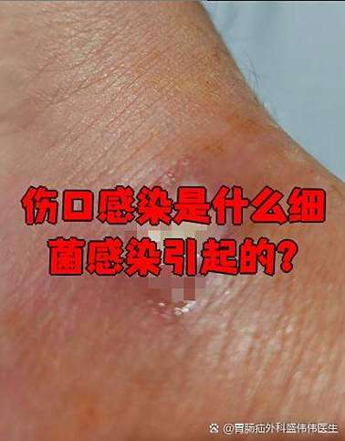 金球菌感染的原因