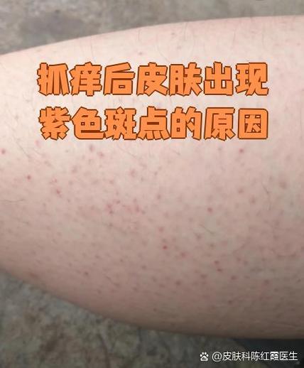 挠痒痒之后的皮肤发紫截图