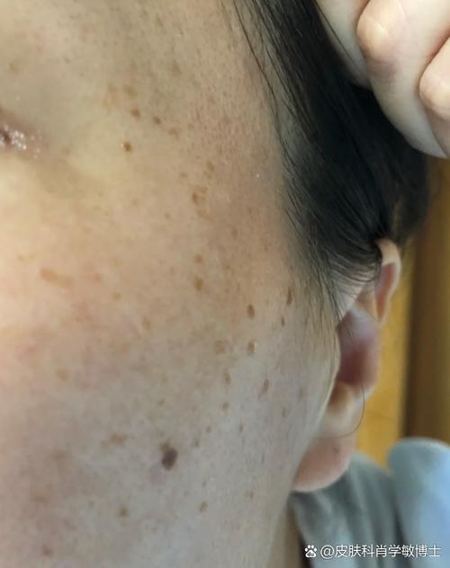 脸上长圆形斑是啥原因
