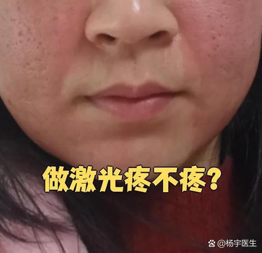 激光能量过高后果