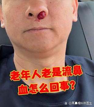 老人流鼻血危险吗