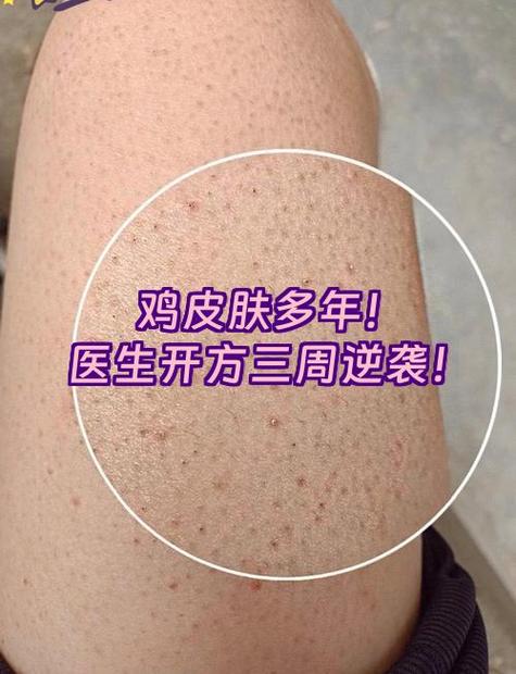 鸡皮肤一般寿命多少年