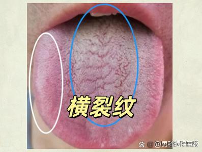 狂燥证的症状
