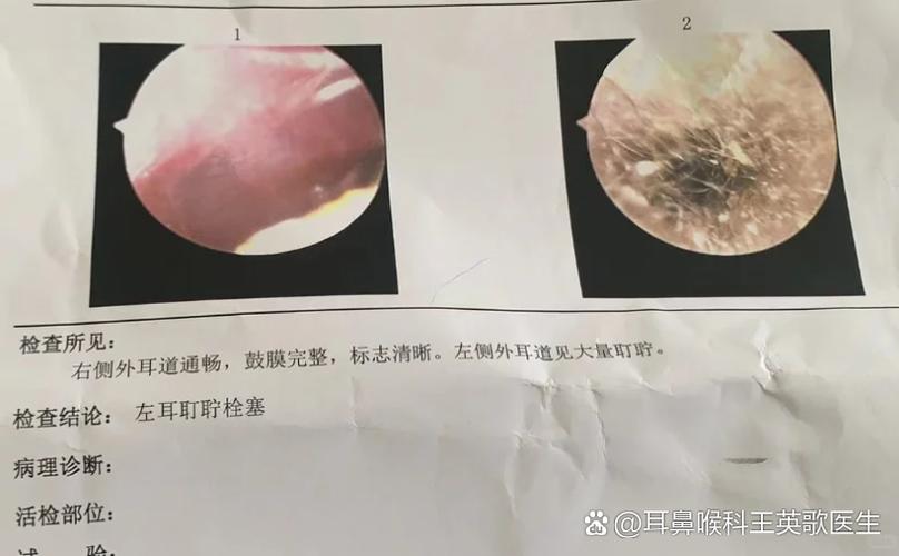 耳朵里面像打鼓一样响是什么原因