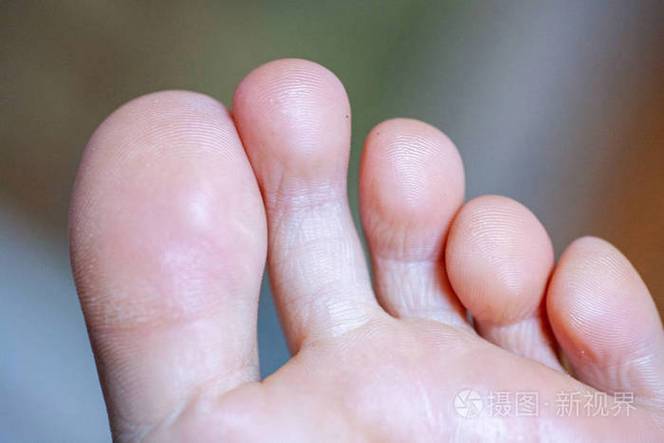 脚趾缝里脱皮是什么原因