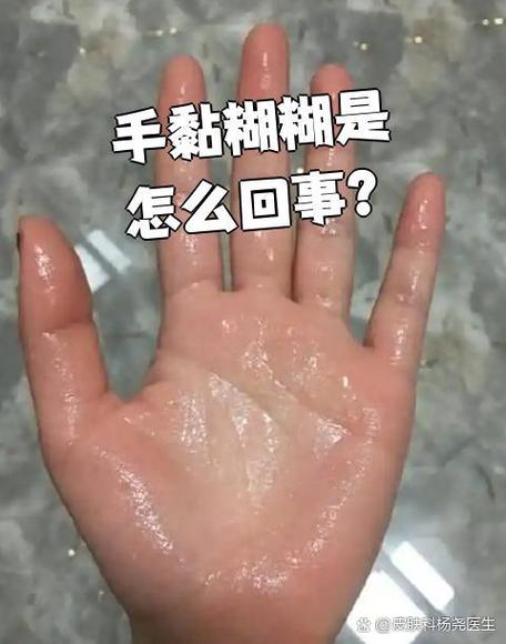 手黏糊糊是怎么回事