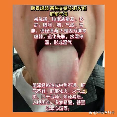 半夏泻心汤的舌象缩略图
