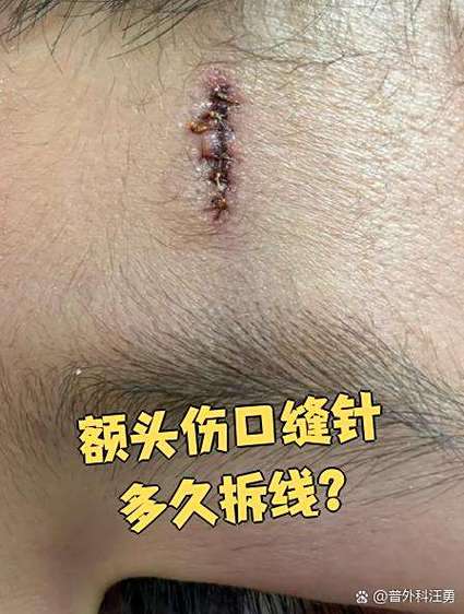 脸部拆完线几天会恢复
